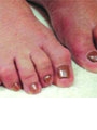 Hammertoe: A Case of Postural Distortions