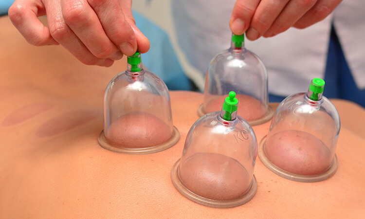 Massage cupping combines well with other modalities, is easy to integrate into a massage session, and is valuable as an assessment tool. 