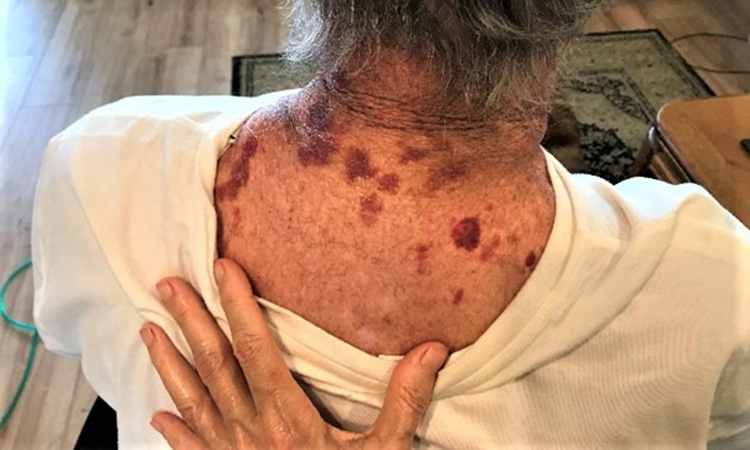 The client in this photo acquired widespread bruising from long-term steroids to manage his dyspnea. These appeared after he wore a collared shirt, indicating how easily bruising can occur. I provided massage for him over a period of eight months and never used more than level 1 pressure, which he loved. (Photo by author.)