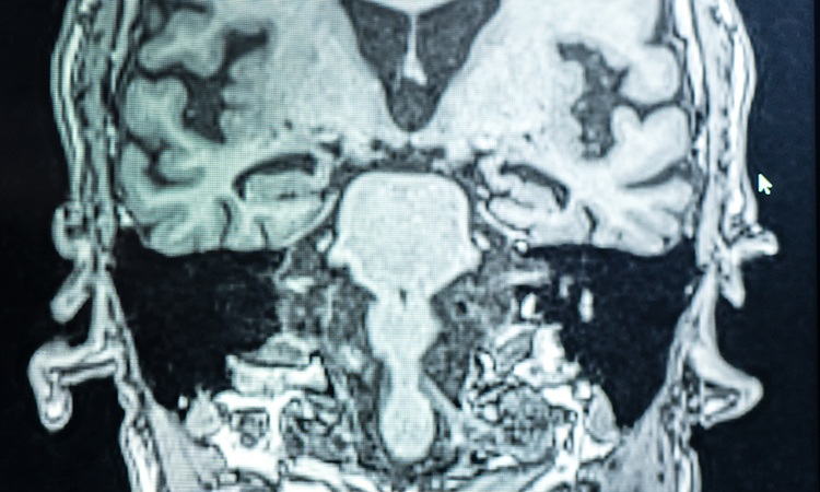 An MRI of a human skull.