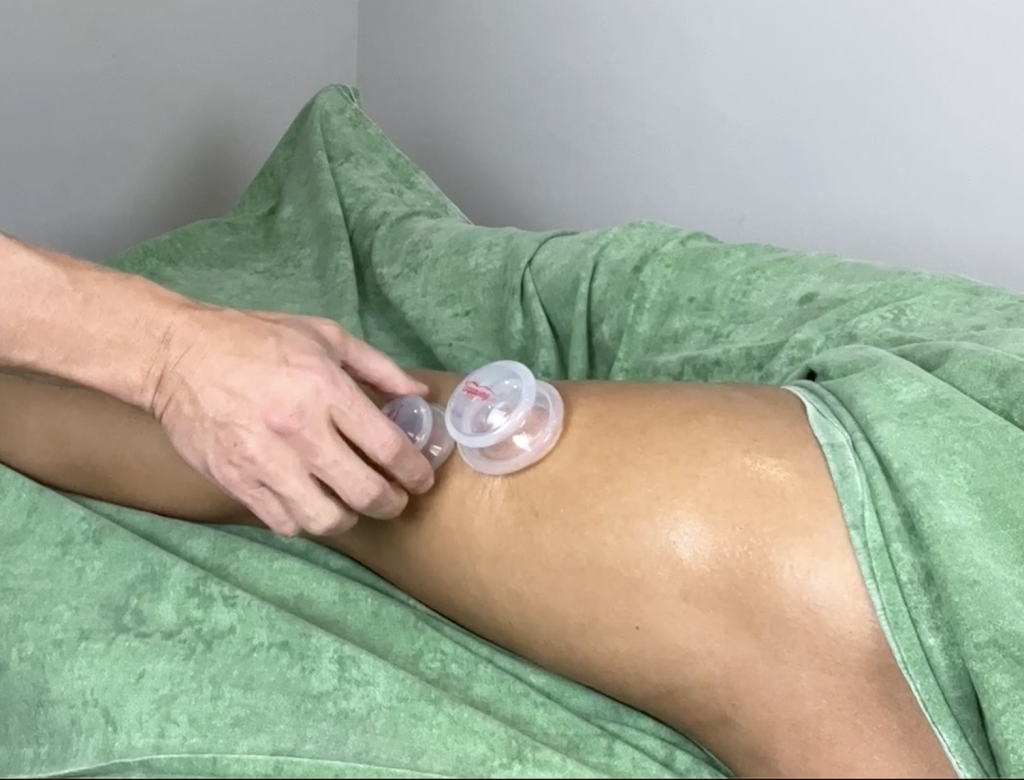 Massage therapists can use cupping to enhance lymphatic circulation and support clients’ health.