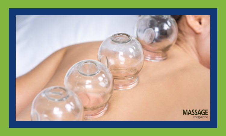 Featured image for a blog about how cupping can be used to relieve headaches and migraines. Image someone receiving cupping therapy. 