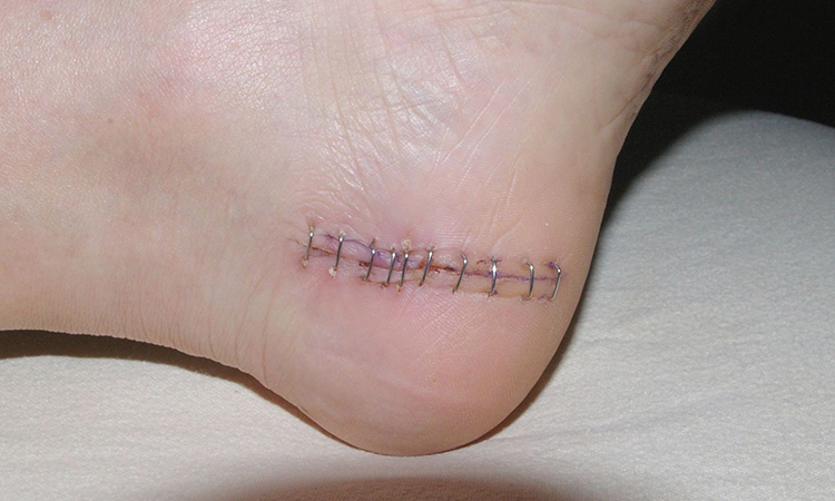 Closeup of an ankle following surgery, with a line closed with medical staples.
