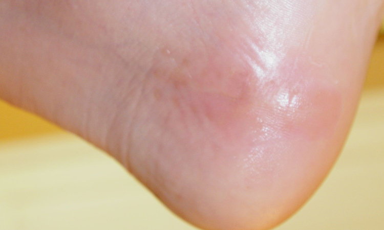 Closeup of an ankle that previously had a scar stapled; now the foot shows little scarring after cupping treatments.