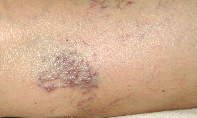 A closeup of skin showing strained blood vessels
