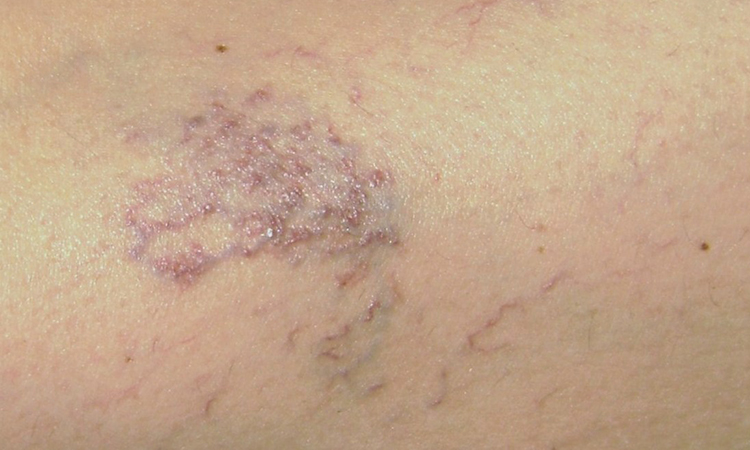A closeup of skin showing strained blood vessels' condition improved after cupping.