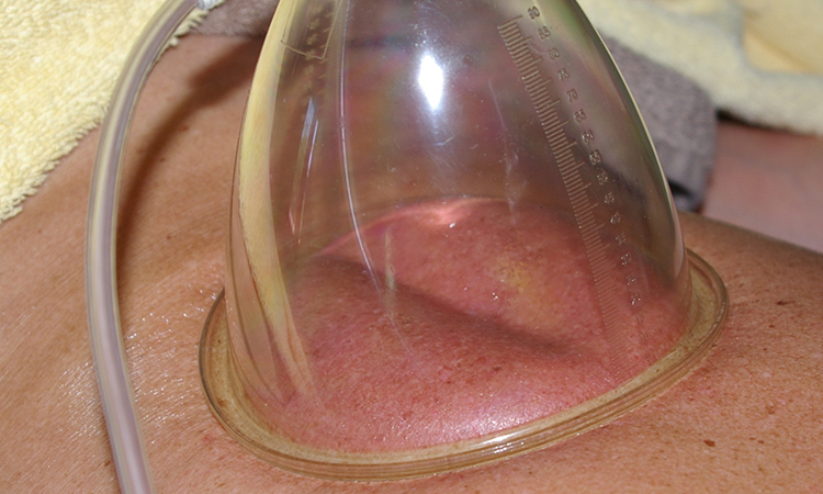 A massage cup pulls skin up into itself, showing the divots that indicate severe restrictions and adhesions.