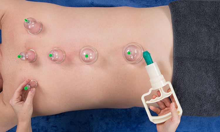 Being a massage therapist requires that we develop good communication skills to simply and easily convey key concepts about our practice to our clients and to referring medical professionals. Clients and others frequently have questions about massage cupping.