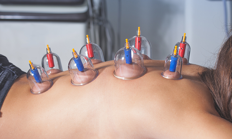 Manual therapy uses vacuum cups and specific techniques to relieve pain along with those compensatory patterns no matter how old the injury may be.