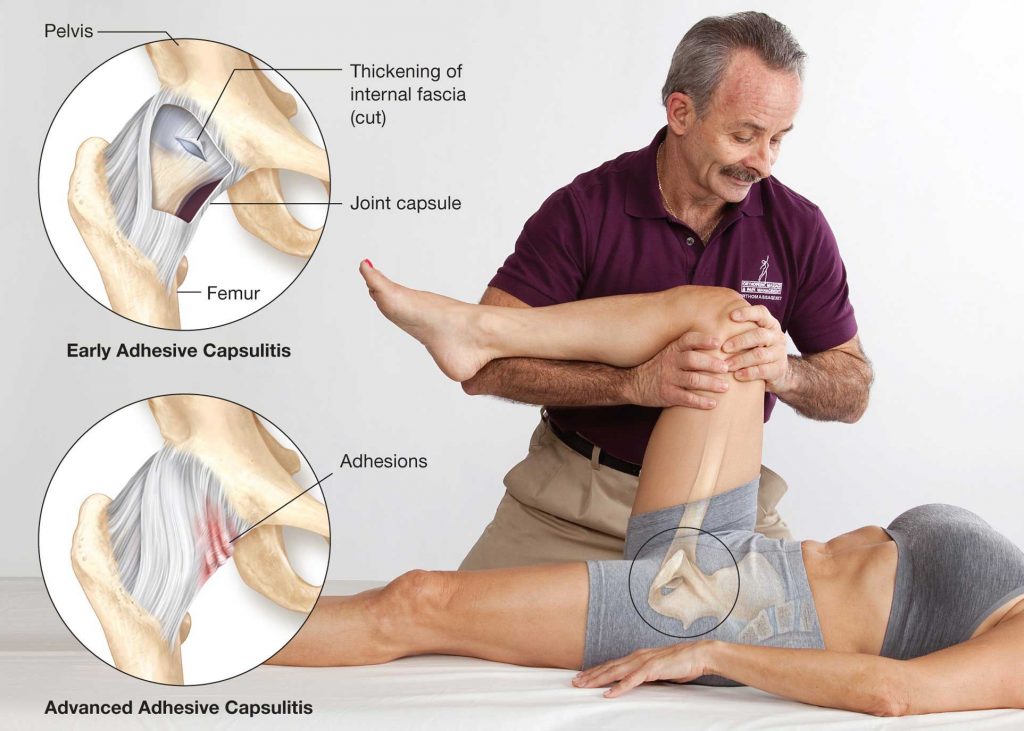Effective manual therapy corrections start with the low back, hip and SI joint pain. The therapist should start by treating the hip capsular patterns (2), then treat the tight psoas (3), and then lift and separate the rectus femoris of the quadriceps (4) to free up the femoral nerve.