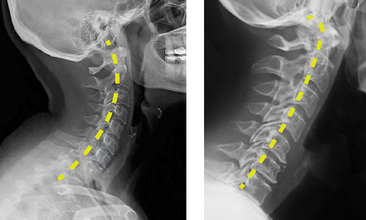 Figure 3. Forward head carriage with loss of cervical curve