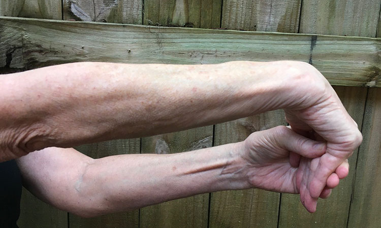 Forearm Extensors