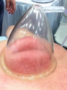 A deep adhesion undergoing vacuum cupping.