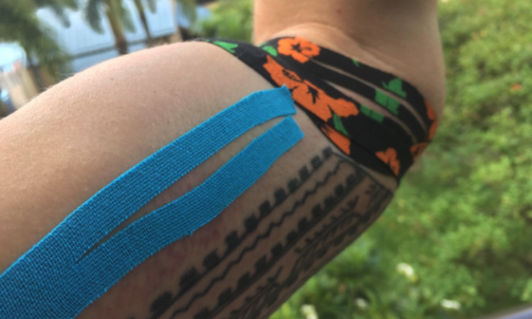Properly using kinesiology tape and IASTM tools when treating lymphedema have proven to be gentle and effective methods of intervention.