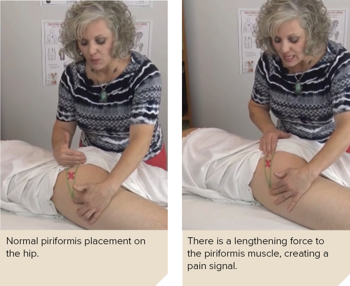 A massage therapist massages a client's piriformis muscle.