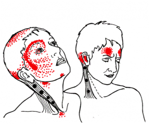 referred pain pattern II