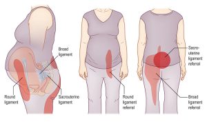Figure 1.7: Referred pain from uterine ligaments. The sacrouterine ligament (darkest shade) is more problematic in the third trimester, whereas round ligament pain (medium shade) is more common in the second trimester. Broad ligament pain (lightest shade) occurs more from the sixth month on and can spread into the lateral thigh as well.