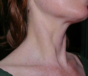 after cupping therapy