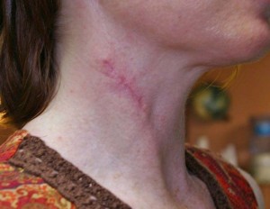 before cupping therapy