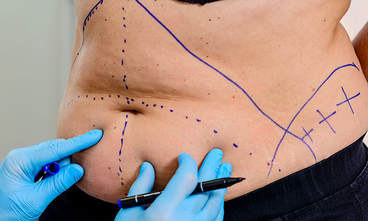 Promoting healing after surgical procedures of all types, including cosmetic-themed procedures, is imperative for healthy recovery of the patient.