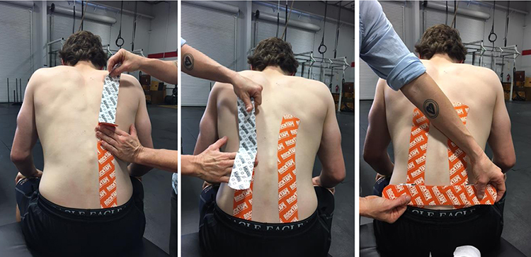 A broad range of complaints bring clients to our treatment tables every day, including chronic pain, injury, mobility issues and the desire to relax. Several issues are common across diverse client populations, however, which warrants taking a closer look at the methods we use for treatment and an analysis of the possible reasons for those issues’ repetitive nature. The Low Back Pain Problem One of the most common chronic conditions in nearly every clinic is related to low back pain. According to the Global Burden of Disease, low back pain is the single leading cause of disability worldwide. The nature of this condition is not only physically debilitating; it also takes a toll on the mental and emotional well-being of those suffering. This mental and emotional response is often overlooked, but it has a significant effect on the client’s ability to recover. As clinicians, it’s vital to take into consideration the psychosocial aspect of the condition as it pertains to our treatment approach. As a species, we are devolving when it comes to our durability and susceptibility to injuries—especially as modern day conveniences evolve. Oftentimes, the chronic low back pain clients suffer is more from a global deficiency of stability and mobility; eventually these imbalances and weaknesses reach their limits. A Clinical Approach There are several clinical approaches that can be used for low back pain, as no two cases are exactly alike, nor are the clinicians treating them. However, there are a few tools we can use consistently when it comes to assessment and treatment. After a thorough intake of medical history from the client, a global view of the client’s posture and movement is a good starting point. This can be as simple as observing the client standing, walking at his or her normal gait, or a more in-depth clinical screen, such as with a Selective Functional Movement Assessment (SFMA), which is a movement-based screen used to help find the source of a client’s pain. Your decision regarding which movement screen you will use depends largely on your level of training and ability to assimilate what you observe, but it doesn’t need to be overcomplicated either. Taking a broader observation lens to the condition you’re addressing, even by simply assessing your client in a seated position, will reveal important clues. The type of screen will also depend on your client’s pain levels and abilities at the time of the session. If the client is capable of moving without significant pain, it serves both of you to attain as much information as possible, even if the assessment isn't formal. Obvious care is to be taken to not create more discomfort, so common clinical sense should be exercised. Identifying Dysfunctions Often, in the case of low back pain, we see postural dysfunctions such as Upper Crossed Syndrome, anterior pelvic tilt, a forward head posture, medially rotated knees and pronation of the feet. Dysfunction in the diaphragm, obliques, pelvic floor and glutes are also some of the prime suspects to investigate. These aren’t hard-and-fast absolutes with every client that complains of low back pain, but they are landmarks to look for when taking a broader view. Observing how the feet and ankles articulate through the pattern of gait is underutilized when dealing with painful conditions farther up the chain as well. More often than not, successful treatment starts with correcting a breathing pattern, restoring stability and addressing postural dysfunction from the ground up. As we continue to have a greater understanding of pain science, thanks to pioneers such as Robert Schleip, Ph.D., and Lorimer Mosely, we have the tools to build our treatment plan from the perspective of our client’s nervous system. Working with this inherently intelligent system rather than against it sets the tone for success. When a client comes in with pain, his or her central nervous system is on guard and in a protective state to prevent any further damage to the area. This is often expressed as limited ranges of motion beyond the affected area, such as shallow, apical breathing, depending on the severity of pain; basic breathing dysfunction; or some degree of hypertonicity throughout their entire body. It’s important to recognize that these are protective mechanisms that the brain is employing. Failure to recognize this will likely have you addressing the site of pain with soft tissue techniques, to which the body will potentially become resistant if the nervous system still perceives a threat and until function and stability are restored. When we take a step back from the site of pain, a holistic view of mechanics can often lead us closer to the major causes or contributors to the problem, barring any known spinal conditions or disc issues. An Effective Approach Helping your client diaphragmatically breathe while on the treatment table is a non-invasive way to decrease tension, as is using lighter strokes the pain receptors would respond to without resistance. As the tension decreases, a graded scale of depth and pressure can be applied based on the client’s tolerance and if deemed clinically necessary. However, based on your initial assessment of posture and movement you should have a good idea of where there are imbalances and dysfunctions. In many cases, the low back is merely the victim of dysfunction elsewhere (disregarding any traumatic injuries or spinal conditions). With this in mind, your treatment approach might start with work to restore function to the diaphragm, the pelvic floor, the obliques and the glutes. Often, when these mechanics are recovered, the hypertonicity in the other musculature will greatly decrease simply by way of balancing the load on the system and decreasing the body’s perceived threat to further injury. This is a prime example of working with a client’s nervous system rather than against it—the opposite of aggressive soft tissue methods trying to force tight and rigid tissues into submission. A balanced system is more receptive to treatment aimed at downregulating tone and pain. Musculature obeys the command of the nervous system, not the other way around. The mechanoreceptors within the dermal layers send information to the brain and respond to touch differently. Tools of the Trade A relaxing touch versus a touch designed to up-regulate a loss of tone will produce a different result in the tissues being addressed. In the case of upper crossed syndrome for example, using an Instrument Assisted Soft Tissue Mobilization (IASTM) tool to produce a rapid stimulating stroke to the erectors of the spine and the middle and lower traps, followed by a slower, more relaxing (down-regulating) stroke on the tighter tissues of the neck extensors and pec minors can create balance by feeding the right information to the brain. Using kinesiology tape as an extension of your work is an extremely effective tool to manage pain and neurosensory feedback in the areas requiring restored function. In the case of low back pain presentation, an application of tape to the site of pain as well as two stabilization strips to the spinal erectors may help decrease pain while simultaneously creating more circulation and lymph flow to the area due to the mechanical creation of distance between tissues. Tape applications to the diaphragm and obliques may also be warranted, since this will directly affect the client’s stability. By bringing more sensory awareness to these areas (with kinesiology tape on the skin), correction of postural imbalances and function may be more readily achieved—especially when coupled with educating the client on breathing, movement mechanics and corrective exercise if that falls within your scope of practice. In each taping application, the tissue being addressed is stretched by passively or actively positioning the client according to his or her pain tolerance and movement ability. When taping the low back at the site of pain, have the client gently lean into a supported position of forward flexion, gently rounding the low back outside the margin of pain. This can be as simple as having the client seated on the table and leaning over to put the hands or elbows on the knees or standing in a rounded forward position with the hands on a stable surface such as the back of a chair. At the site of pain, place a decompression strip with approximately 50 percent stretch over the area and then no stretch whatsoever on the ends of the tape. In all taping applications the ends should have no tension on them to avoid any skin irritation. Two longer strips are placed on either side of the spine over the erectors. No stretch is necessary, as these are not serving as decompression strips but rather stabilizers. Having the client return to a normal stance will reveal small ripples in the tape representing the mechanical lifting effect on the tissue. Taping applications will last anywhere between three to five days. Using soap and water or baby oil can help emulsify the adhesive for an easier removal process. In the case of special populations such as geriatrics, pediatrics, pregnant women or clients with sensitive skin issues, use of a more gentle tape designed for these demographics is recommended. Before any extensive application of kinesiology tape, it’s wise to place a 2-inch test strip either at the intended site or on the forearm to determine tissue tolerance. For more information regarding the use of kinesiology taping in your practice, seek out a qualified training course. Many Approaches As this article indicates, there isn’t just one approach to take when assessing a client’s low back pain. Utilizing a screen such as the SFMA as your basis for evaluation accompanied by the use of IASTM or taping are all valuable interventions to help you address the low back pain that plagues so many of today’s clients. About the Author Stacey Thomas, L.M.T., S.F.M.A., F.M.S., N.K.T., C.F.-L2, has been dedicated to human movement and athletic performance since 1997 and certified as a sports massage therapist since 2005. She holds certification in Functional Movement Screen, Selective Functional Movement Assessment, Neurokinetic Therapy and CrossFit Level 2, as well as other training and soft tissue modalities. She is credentialed by educational organizations regarding human movement and soft tissue treatment. You can find her in one of her three Front Range, Colorado, clinics treating athletes or teaching courses for RockTape. If you enjoyed reading this MASSAGE Magazine online article, subscribe to the monthly print magazine for more articles about massage news, techniques, self-care, research, business and more, delivered monthly. Subscribe to our e-newsletter for additional unique content, including product announcements and special offers