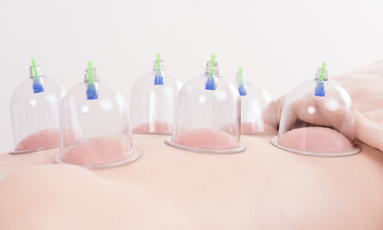 Five massage cups shown on a person's back.