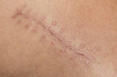 Working with scars and stretch marks offers an opportunity to explore the deepest aspects of the human condition. Explore the world of scar tissue massage.